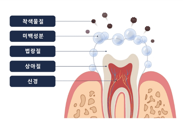 치아미백 치료 과정