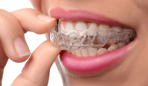 인비절라인 치아교정