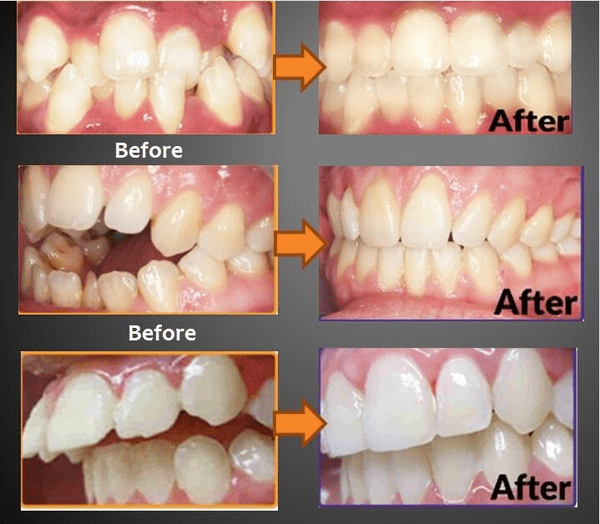 치아교정 효과