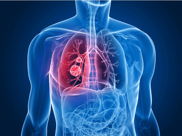폐 관련 질환