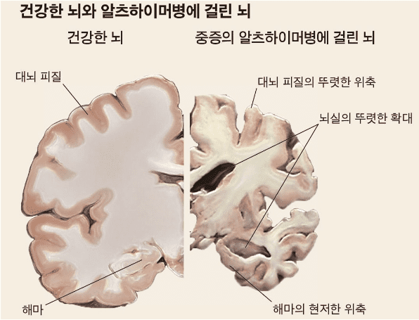 알츠하이머병 환자 뇌