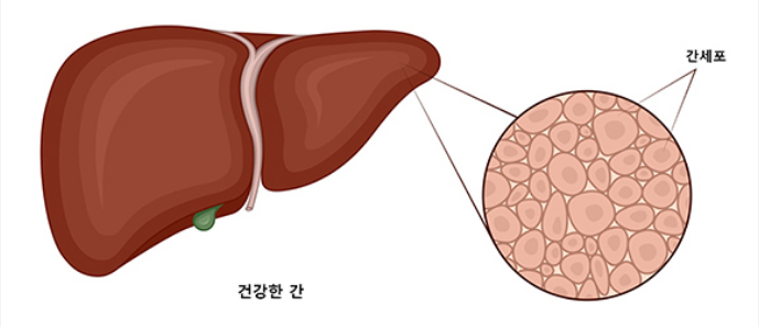 지방간 질환 원인 예방법 증상 진단 치료 식이요법