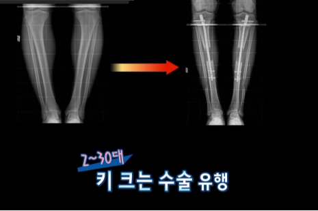 키 성장 수술 종합 가이드 – 수술 비용과 부작용 상세 분석